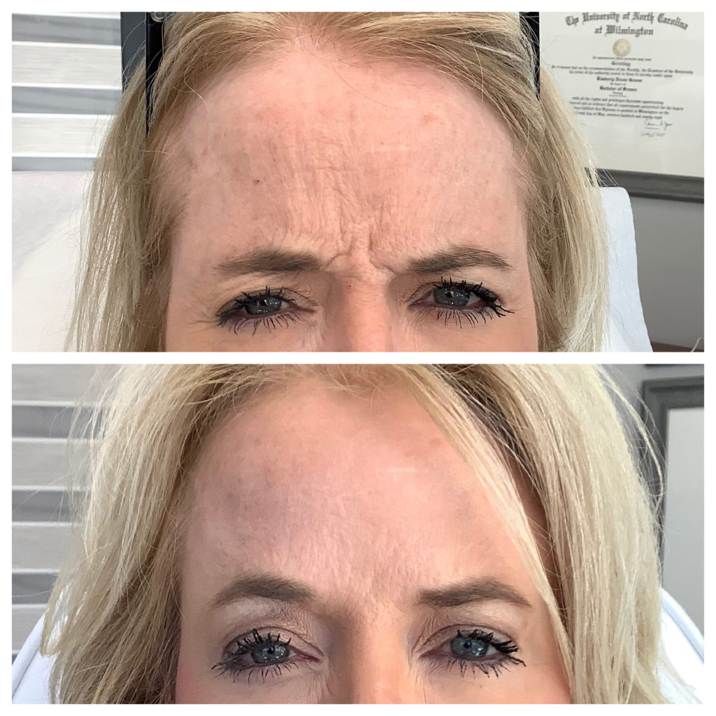 Botox & Dysport Before and After Photo by Kim Engelhardt, MSN, APRN, ANP-BC in Brentwood, Tennessee