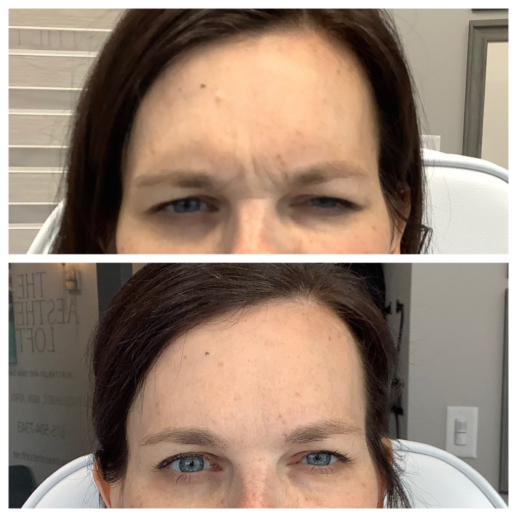Botox & Dysport Before and After Photo by Kim Engelhardt, MSN, APRN, ANP-BC in Brentwood, Tennessee