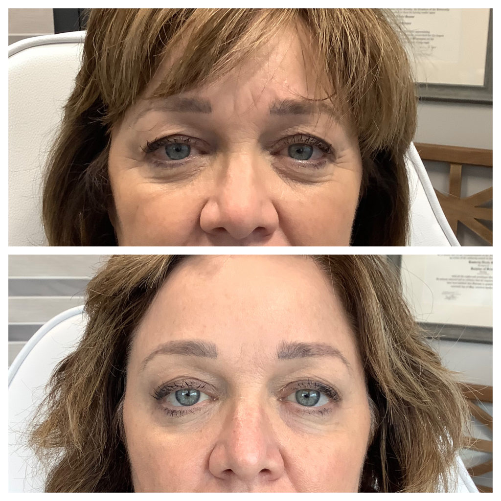 Botox & Dysport Before and After Photo by Kim Engelhardt, MSN, APRN, ANP-BC in Brentwood, Tennessee