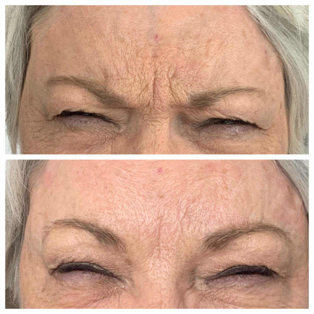 Botox & Dysport Before and After Photo by Kim Engelhardt, MSN, APRN, ANP-BC in Brentwood, Tennessee