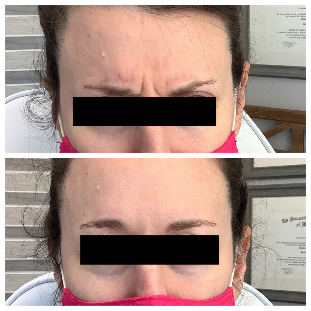 Botox & Dysport Before and After Photo by Kim Engelhardt, MSN, APRN, ANP-BC in Brentwood, Tennessee