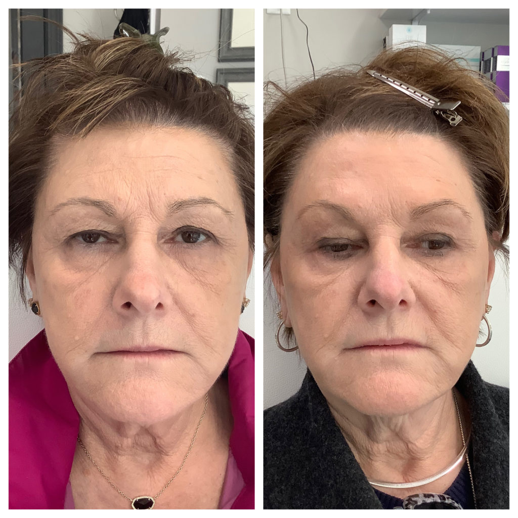 Botox & Dysport Before and After Photo by Kim Engelhardt, MSN, APRN, ANP-BC in Brentwood, Tennessee