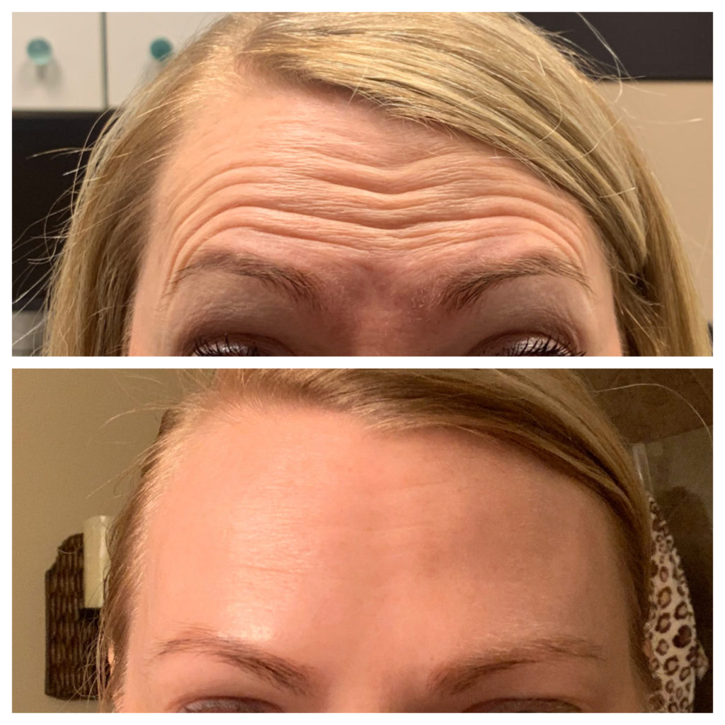 Botox & Dysport Before and After Photo by Kim Engelhardt, MSN, APRN, ANP-BC in Brentwood, Tennessee