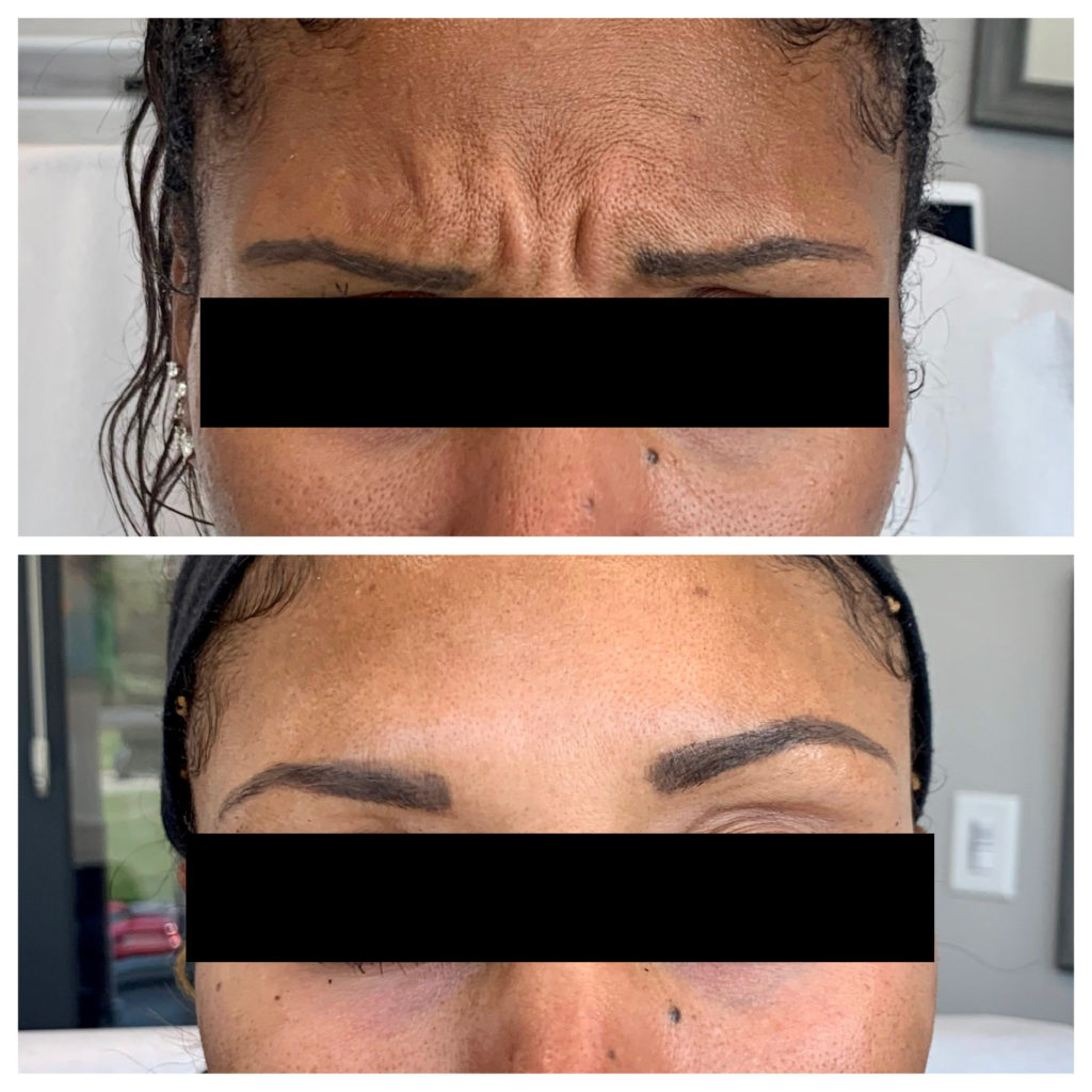Botox & Dysport Before and After Photo by Kim Engelhardt, MSN, APRN, ANP-BC in Brentwood, Tennessee