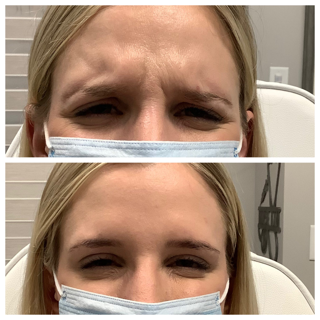 Botox & Dysport Before and After Photo by Kim Engelhardt, MSN, APRN, ANP-BC in Brentwood, Tennessee