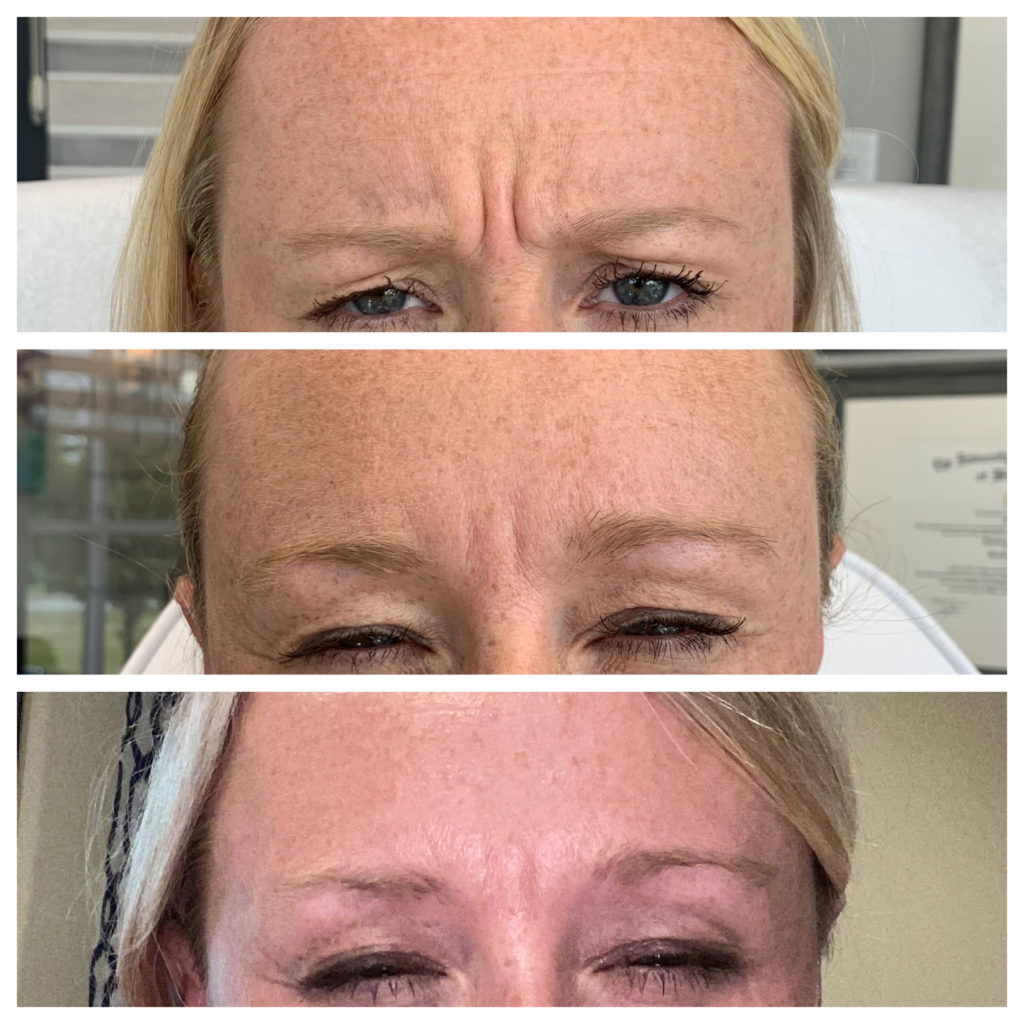 Botox & Dysport Before and After Photo by Kim Engelhardt, MSN, APRN, ANP-BC in Brentwood, Tennessee