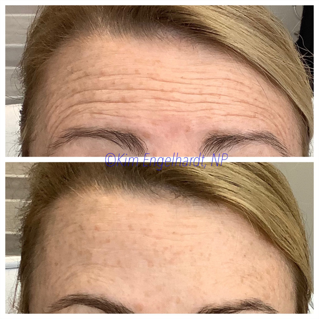 Botox & Dysport Before and After Photo by Kim Engelhardt, MSN, APRN, ANP-BC in Brentwood, Tennessee