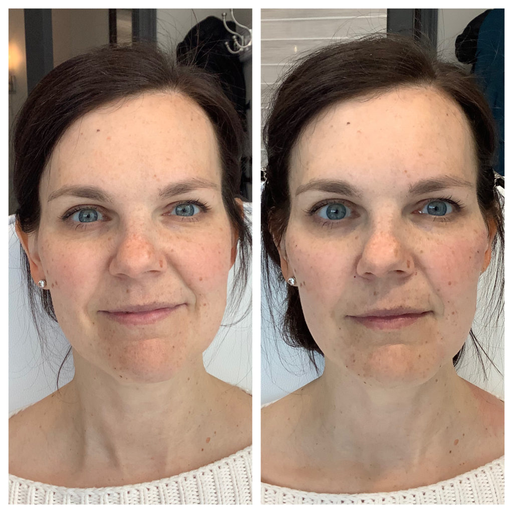 Filler Before and After Photo by Kim Engelhardt, MSN, APRN, ANP-BC in Brentwood, Tennessee