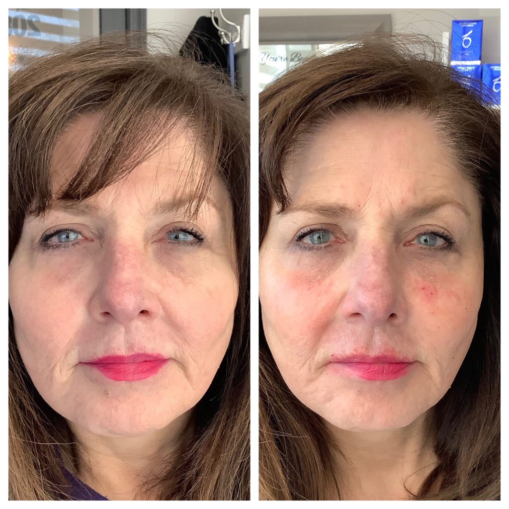 Filler Before and After Photo by Kim Engelhardt, MSN, APRN, ANP-BC in Brentwood, Tennessee