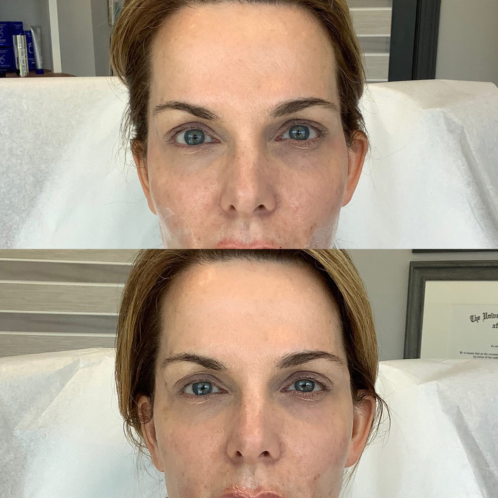 Filler Before and After Photo by Kim Engelhardt, MSN, APRN, ANP-BC in Brentwood, Tennessee