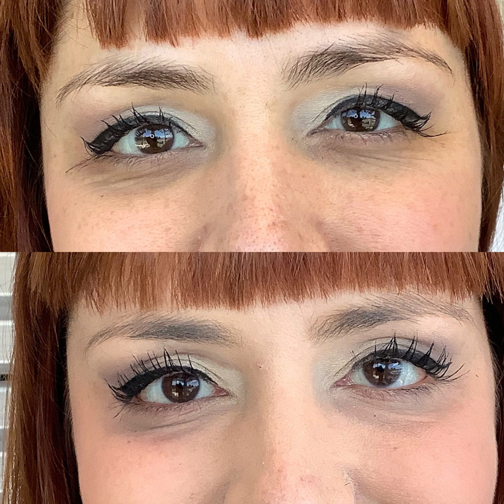 Filler Before and After Photo by Kim Engelhardt, MSN, APRN, ANP-BC in Brentwood, Tennessee