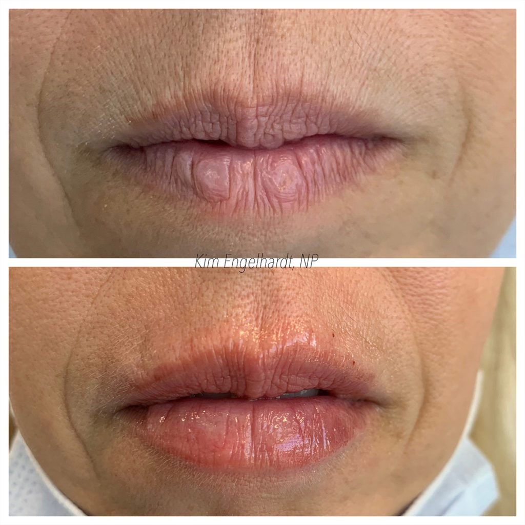 Lip Filler Before and After Photo by Kim Engelhardt, MSN, APRN, ANP-BC in Brentwood, Tennessee
