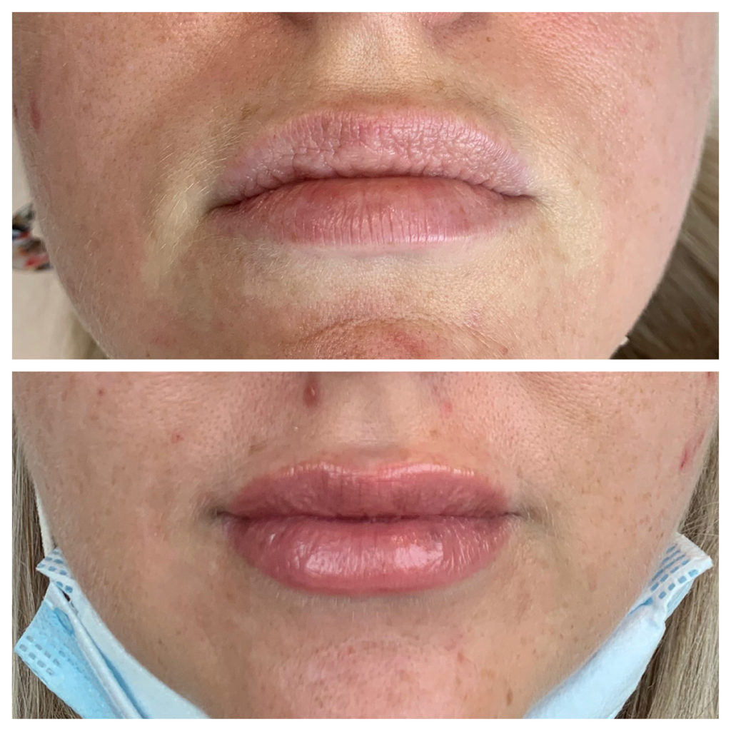 Lip Filler Before and After Photo by Kim Engelhardt, MSN, APRN, ANP-BC in Brentwood, Tennessee