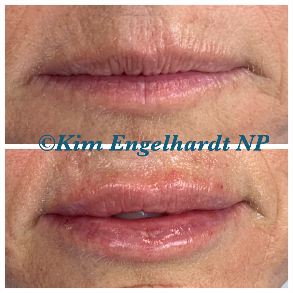 Lip Filler Before and After Photo by Kim Engelhardt, MSN, APRN, ANP-BC in Brentwood, Tennessee