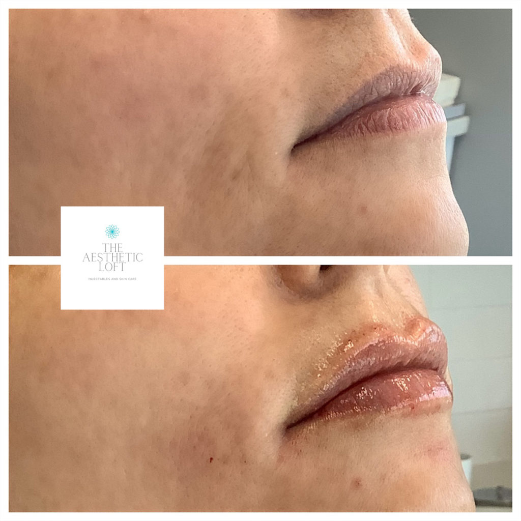 Lip Filler Before and After Photo by Kim Engelhardt, MSN, APRN, ANP-BC in Brentwood, Tennessee