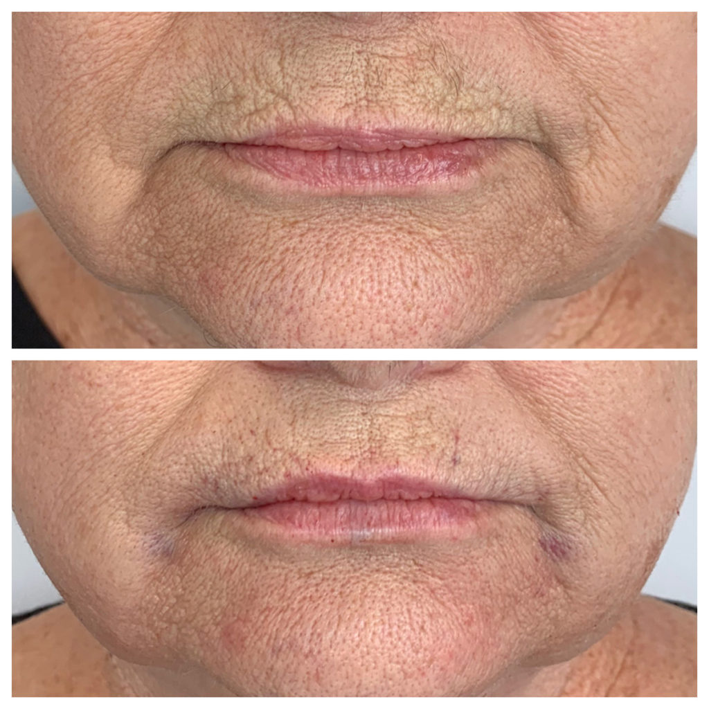 Lip Filler Before and After Photo by Kim Engelhardt, MSN, APRN, ANP-BC in Brentwood, Tennessee