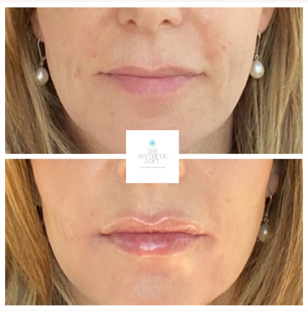 Lip Filler Before and After Photo by Kim Engelhardt, MSN, APRN, ANP-BC in Brentwood, Tennessee