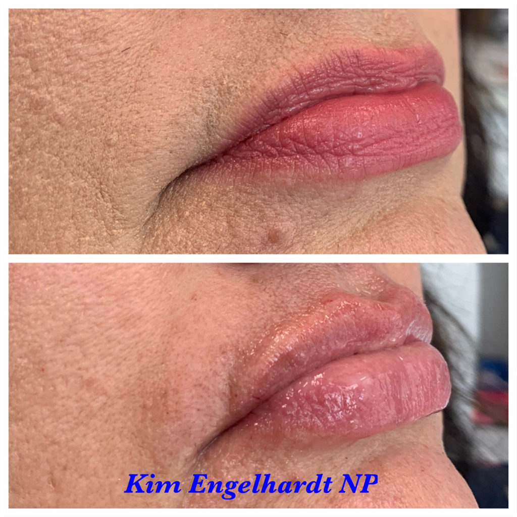 Lip Filler Before and After Photo by Kim Engelhardt, MSN, APRN, ANP-BC in Brentwood, Tennessee