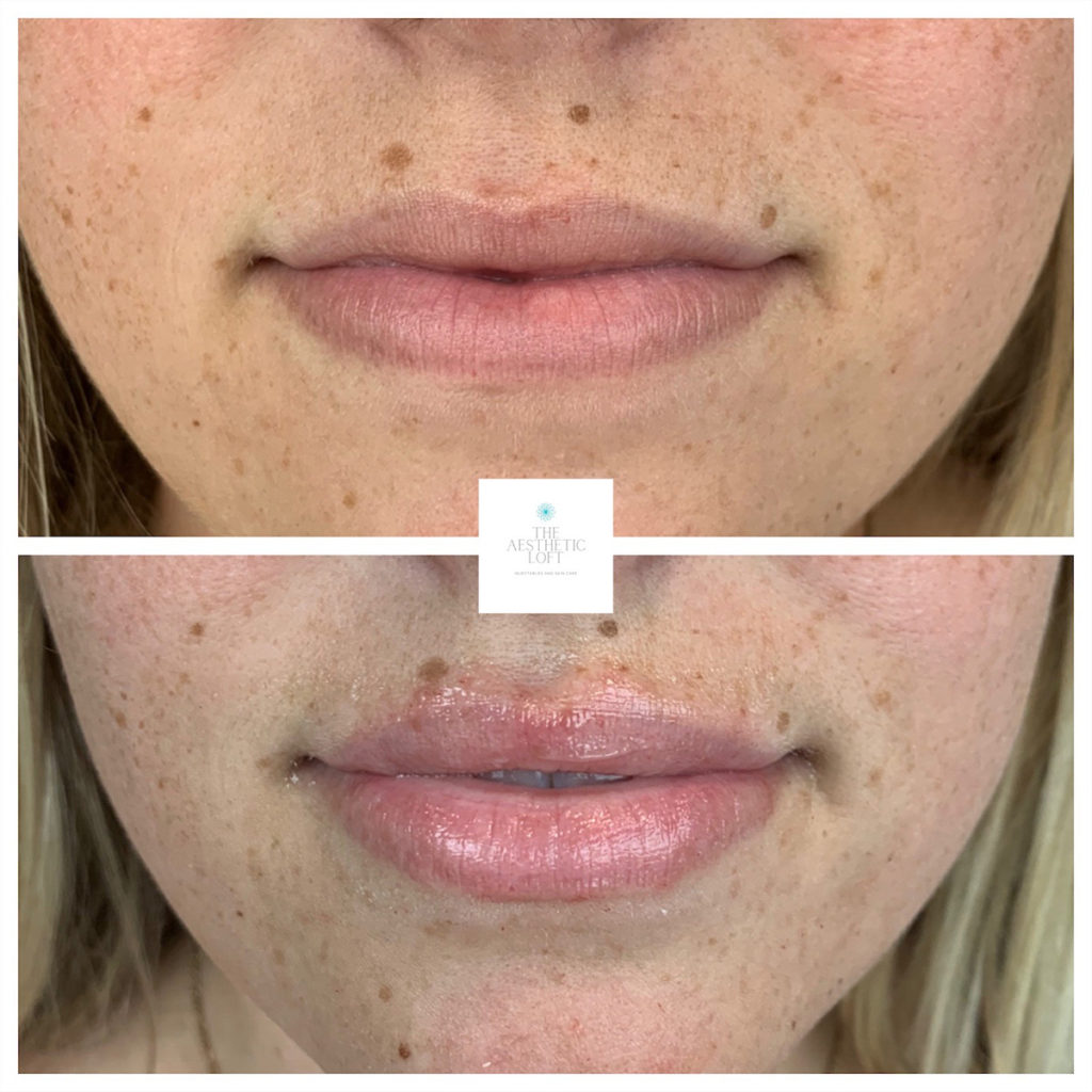Lip Filler Before and After Photo by Kim Engelhardt, MSN, APRN, ANP-BC in Brentwood, Tennessee