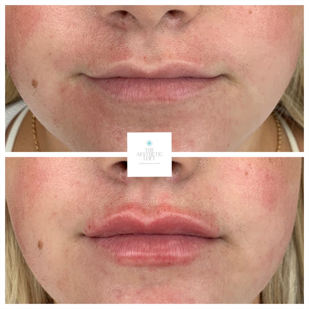 Lip Filler Before and After Photo by Kim Engelhardt, MSN, APRN, ANP-BC in Brentwood, Tennessee