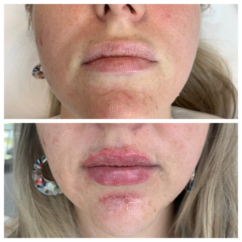 Lip Filler Before and After Photo by Kim Engelhardt, MSN, APRN, ANP-BC in Brentwood, Tennessee