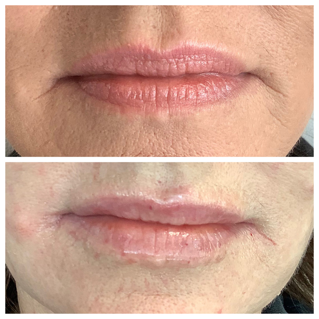 Lip Filler Before and After Photo by Kim Engelhardt, MSN, APRN, ANP-BC in Brentwood, Tennessee