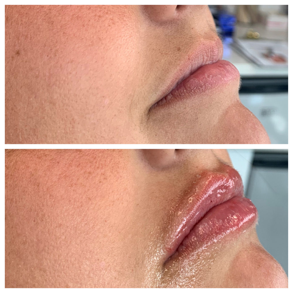 Lip Filler Before and After Photo by Kim Engelhardt, MSN, APRN, ANP-BC in Brentwood, Tennessee