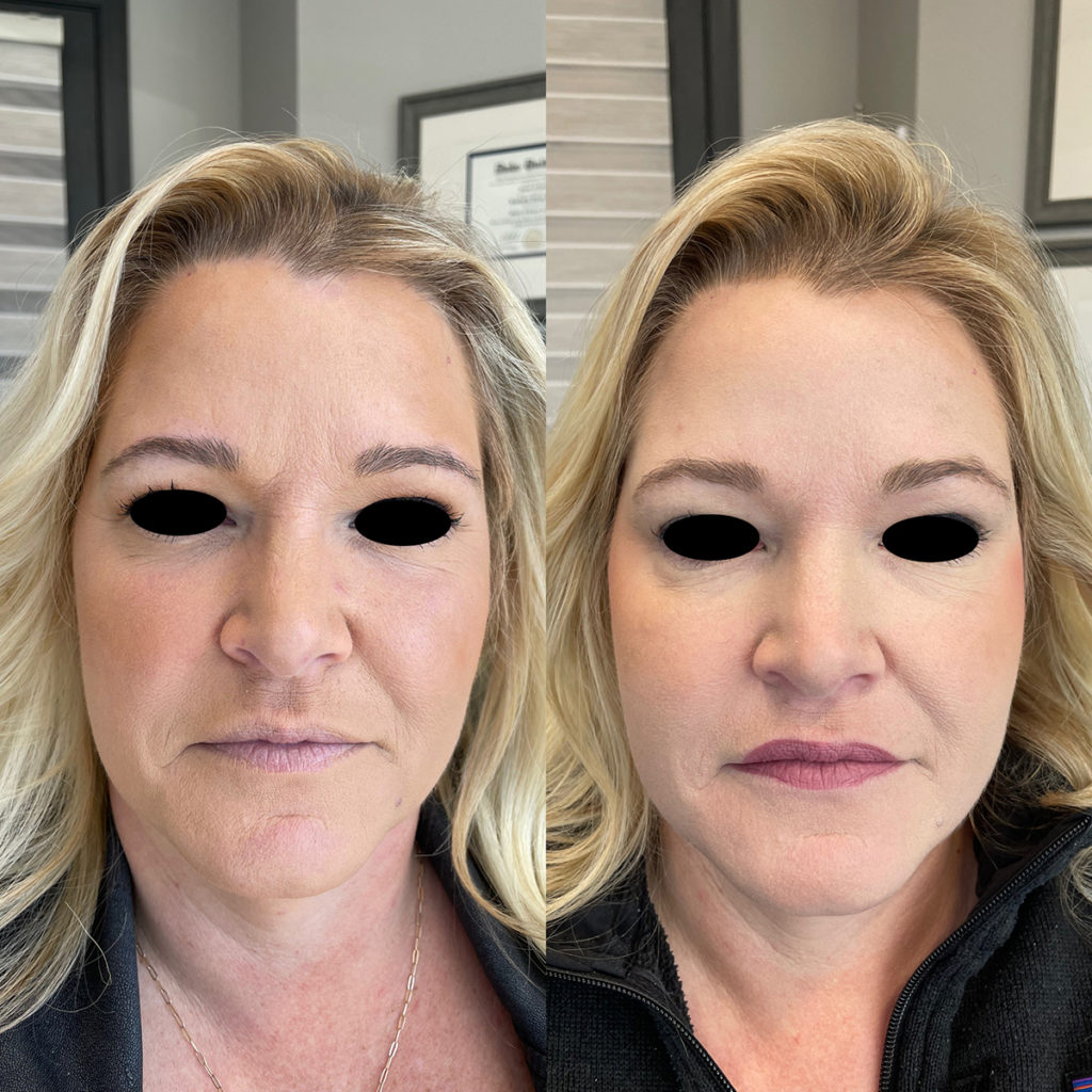 Botox & Dysport Before and After Photo by Kim Engelhardt, MSN, APRN, ANP-BC in Brentwood, Tennessee