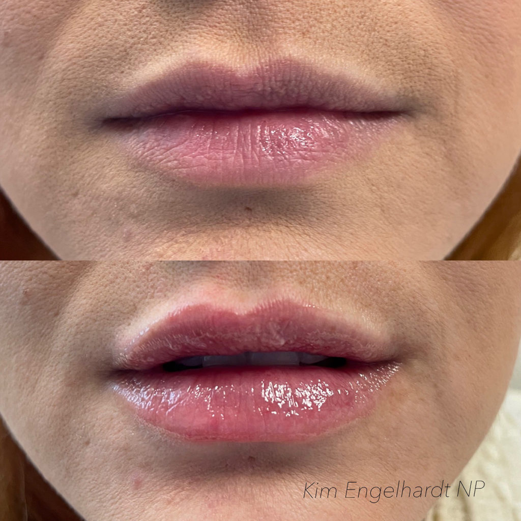 Lip Filler Before and After Photo by Kim Engelhardt, MSN, APRN, ANP-BC in Brentwood, Tennessee
